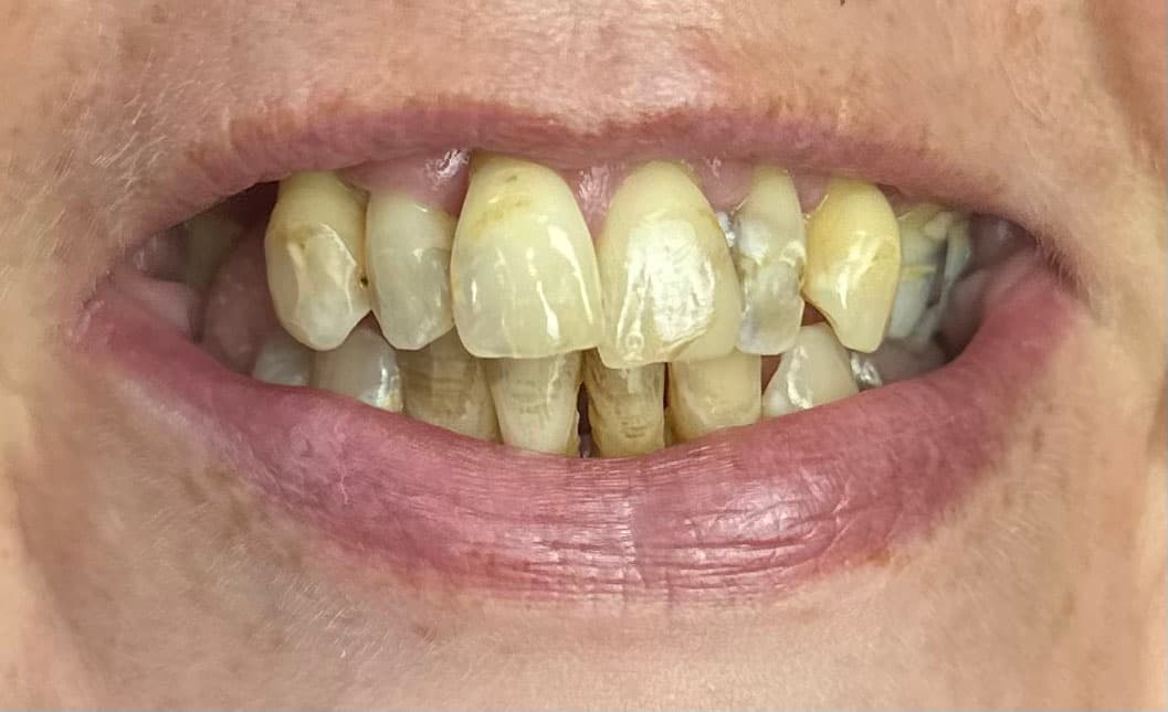 Before All-on-6 Dental Implants