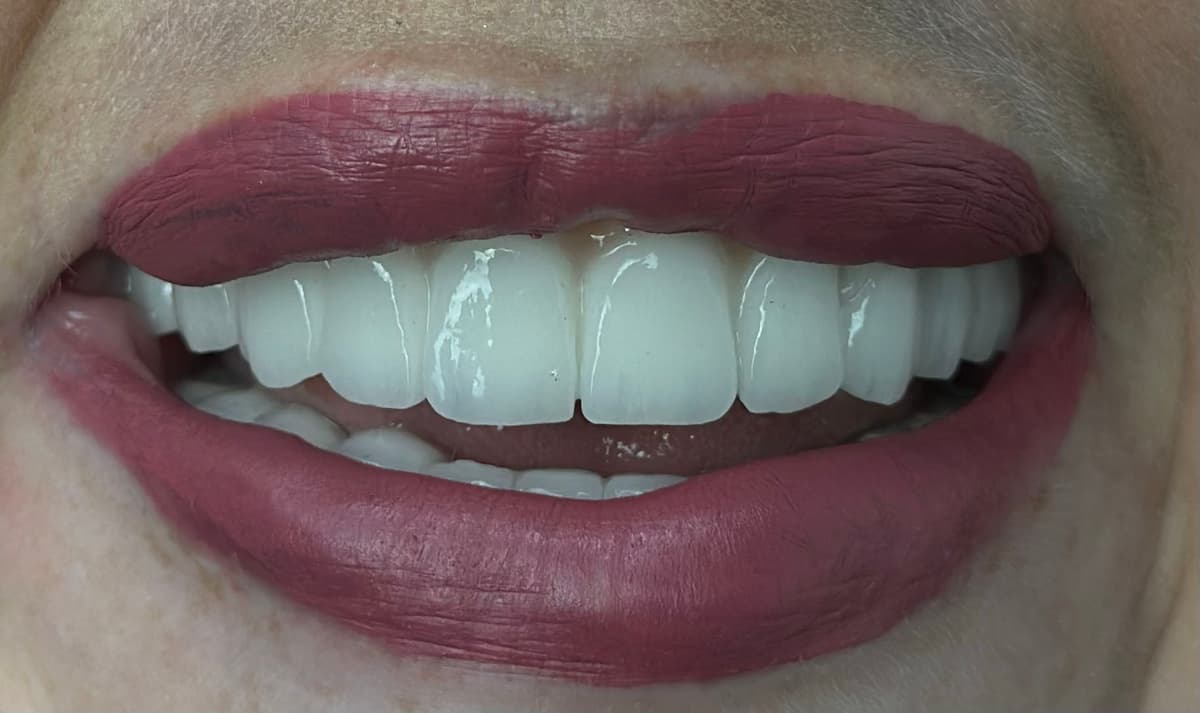 After All-on-6 Dental Implants