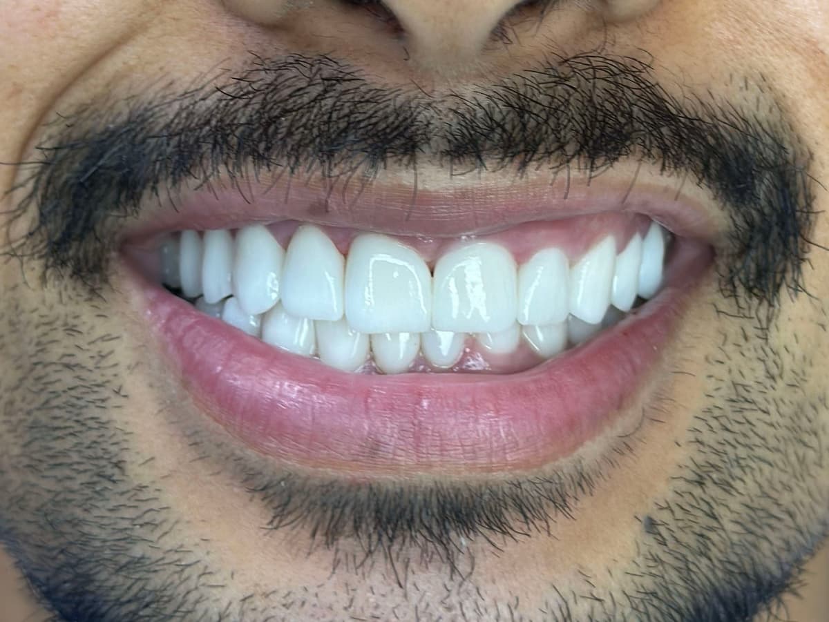After Emax Veneers