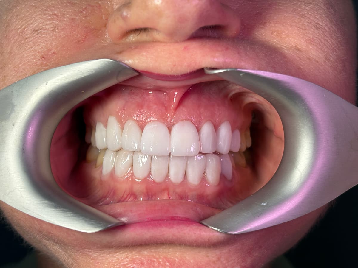 After Emax Veneers